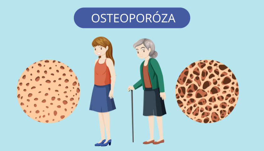 Osteoporóza? Ne, děkuji! 10 tipů pro prevenci