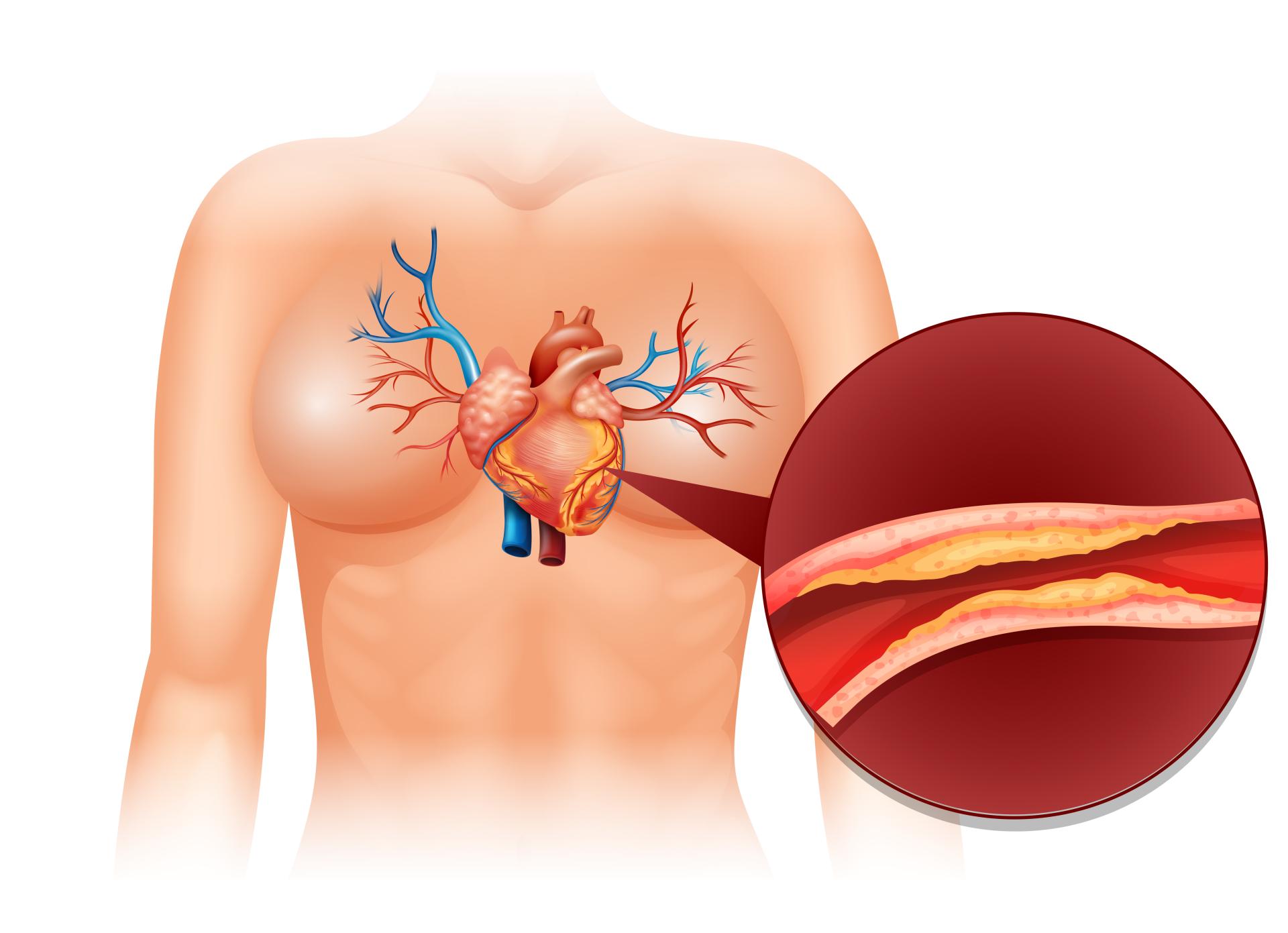 Senioři a cholesterol